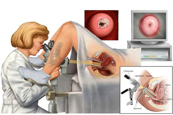 Nữ giới bị viêm lộ tuyến độ 2 không đốt có được không?