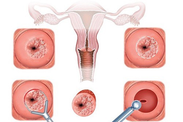 Phương pháp đốt viêm lộ tuyến cổ tử cung là gì? 1