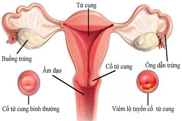 Tìm hiểu về bệnh viêm lộ tuyến cổ tử cung