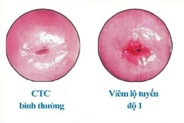 Hiểu rõ về viêm lộ tuyến cổ tử cung độ 1