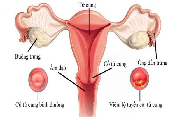 Ở giai đoạn 1, viêm lộ tuyến cổ tử cung có một số triệu chứng chưa rõ nét