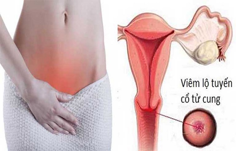 Ra nhiều bã đậu ở âm đạo có thể là do viêm lộ tuyến cổ tử cung