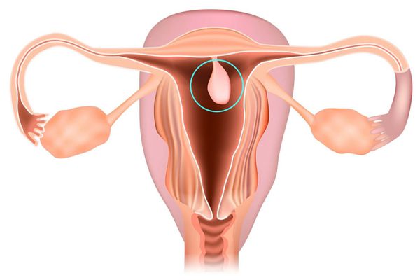 Polyp cổ tử cung là bệnh lý phụ nữ thường gặp