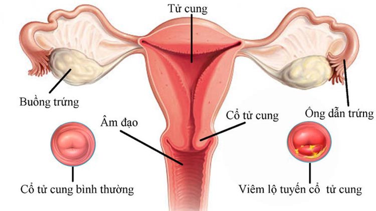 2 - Viêm lộ tuyến cổ tử cung 1