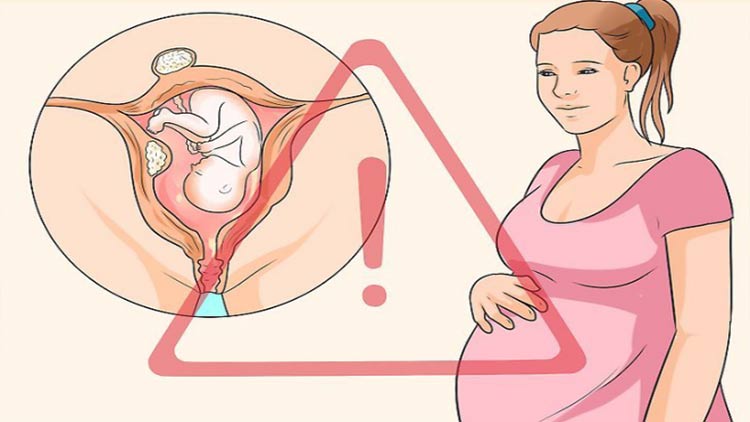 Ảnh hưởng của u xơ tử cung lên quá trình mang thai? 1