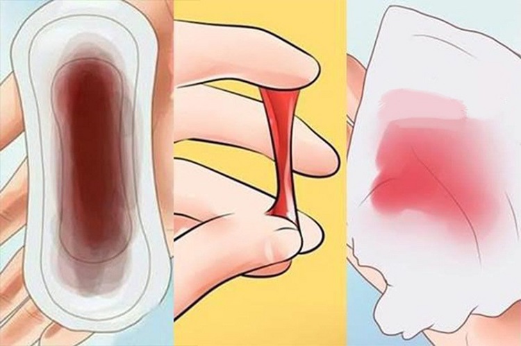 Khi bạn bị chảy máu âm đạo bất thường rất có thể bạn đã bị ung thư cổ tử cung 