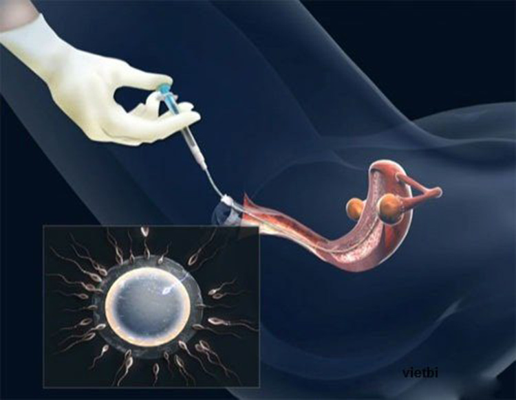Bơm tinh trùng vào buồng tử cung (IUI) 1