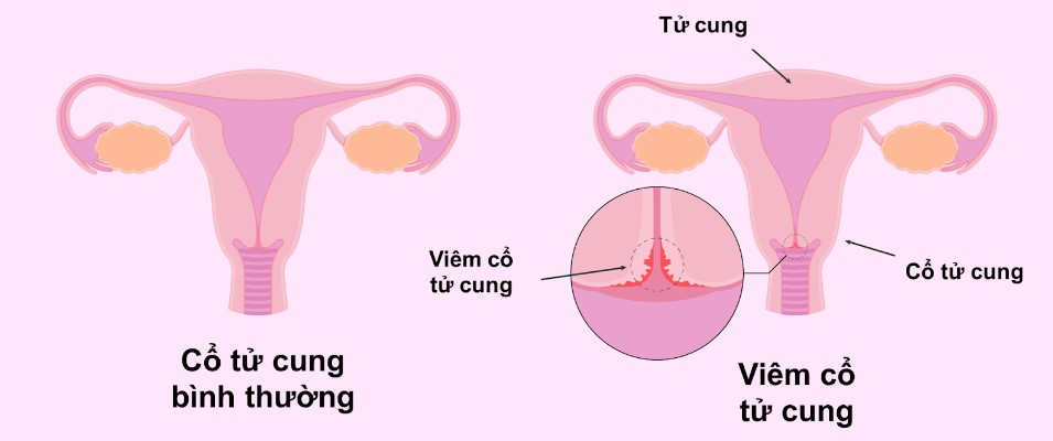 Viêm cổ tử cung là bệnh gì? 1