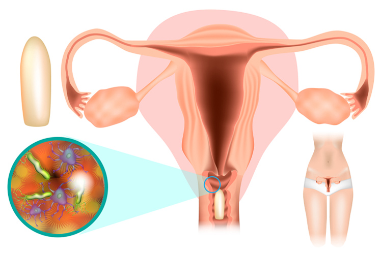 Viêm cổ tử cung ở mức độ nào có thể điều trị tại nhà? 1