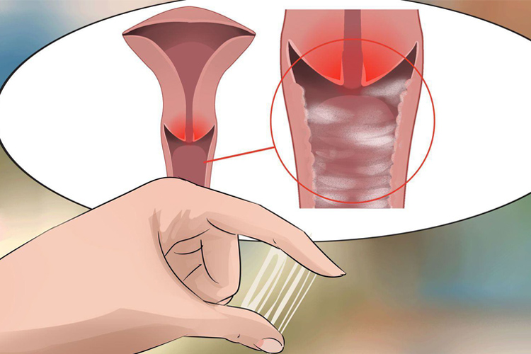 Dấu hiệu nhận biết viêm cổ tử cung nhẹ 1